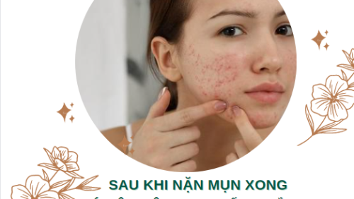 Sau khi nặn mụn xong có nên bôi kem chống nắng không ?