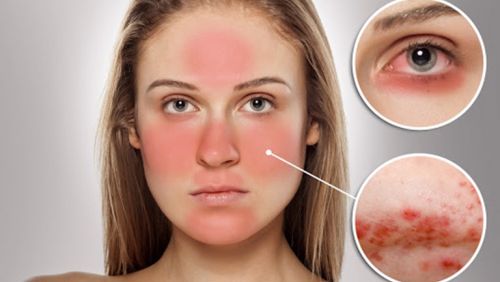 Dị ứng mỹ phẩm có tự hết không, phải làm sao ?