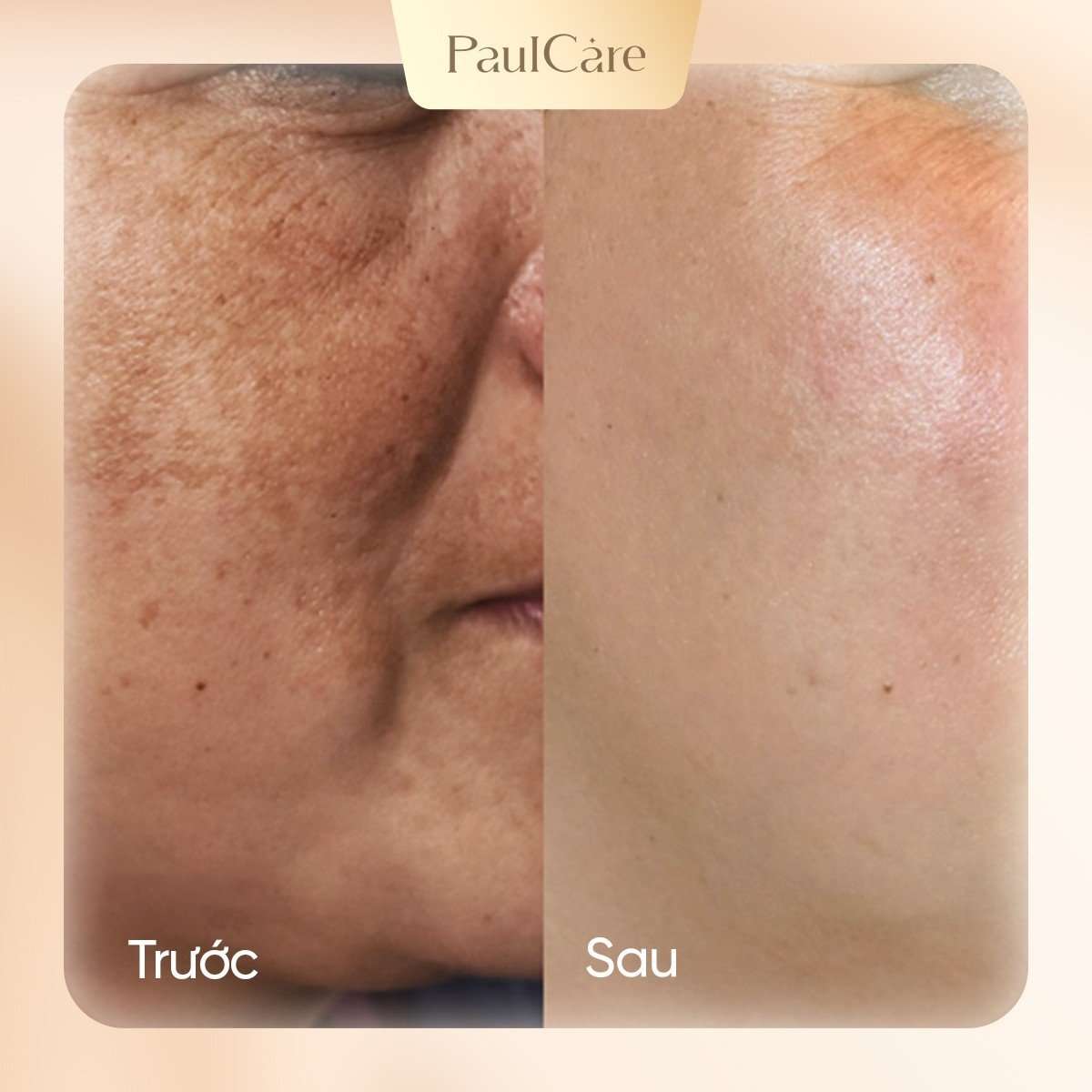 truoc_va_sau_dieu_tri_nam_paulcare_03