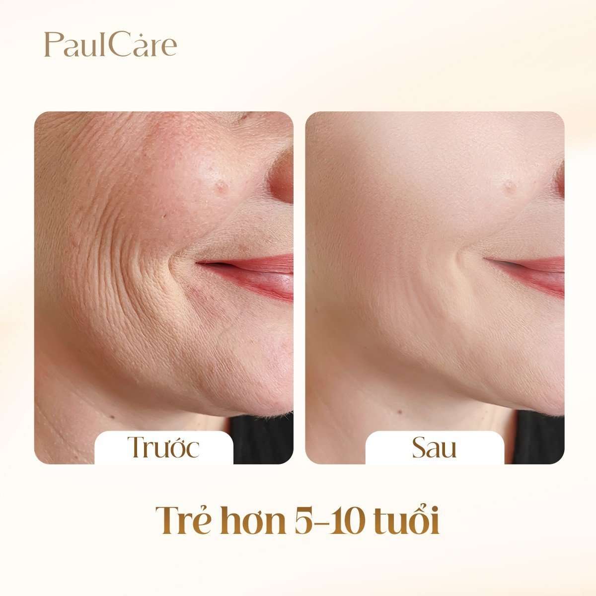 truoc_va_sau_cang_chi_collagen_paulcare