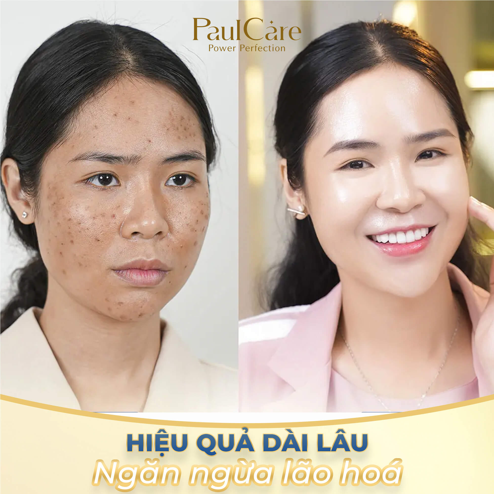truoc_va_sau_khi_Cay_collagen_tuoi_tham_my_vien_paulcare