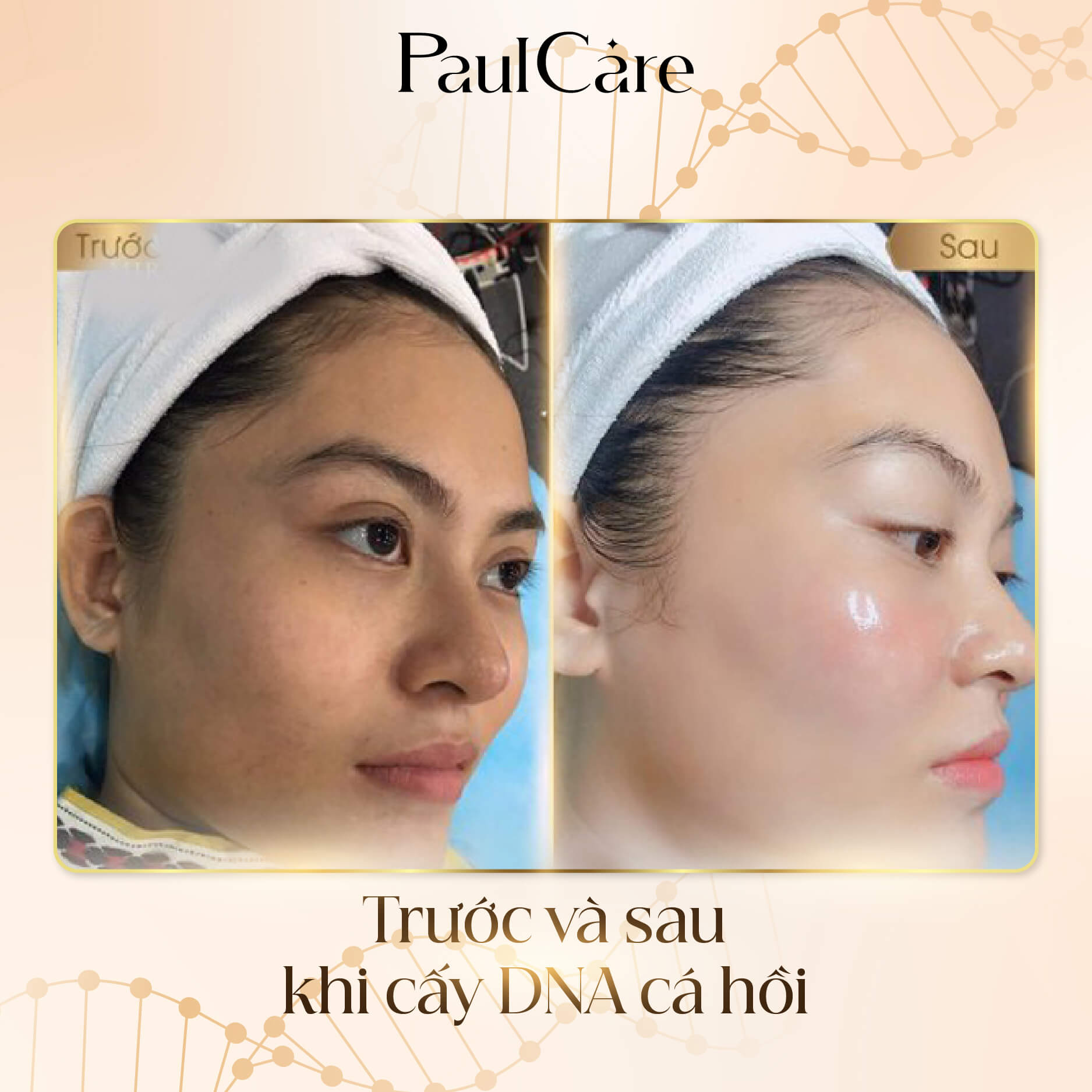truoc_sau_khi_cay-dna_ca_hoi_paulcare