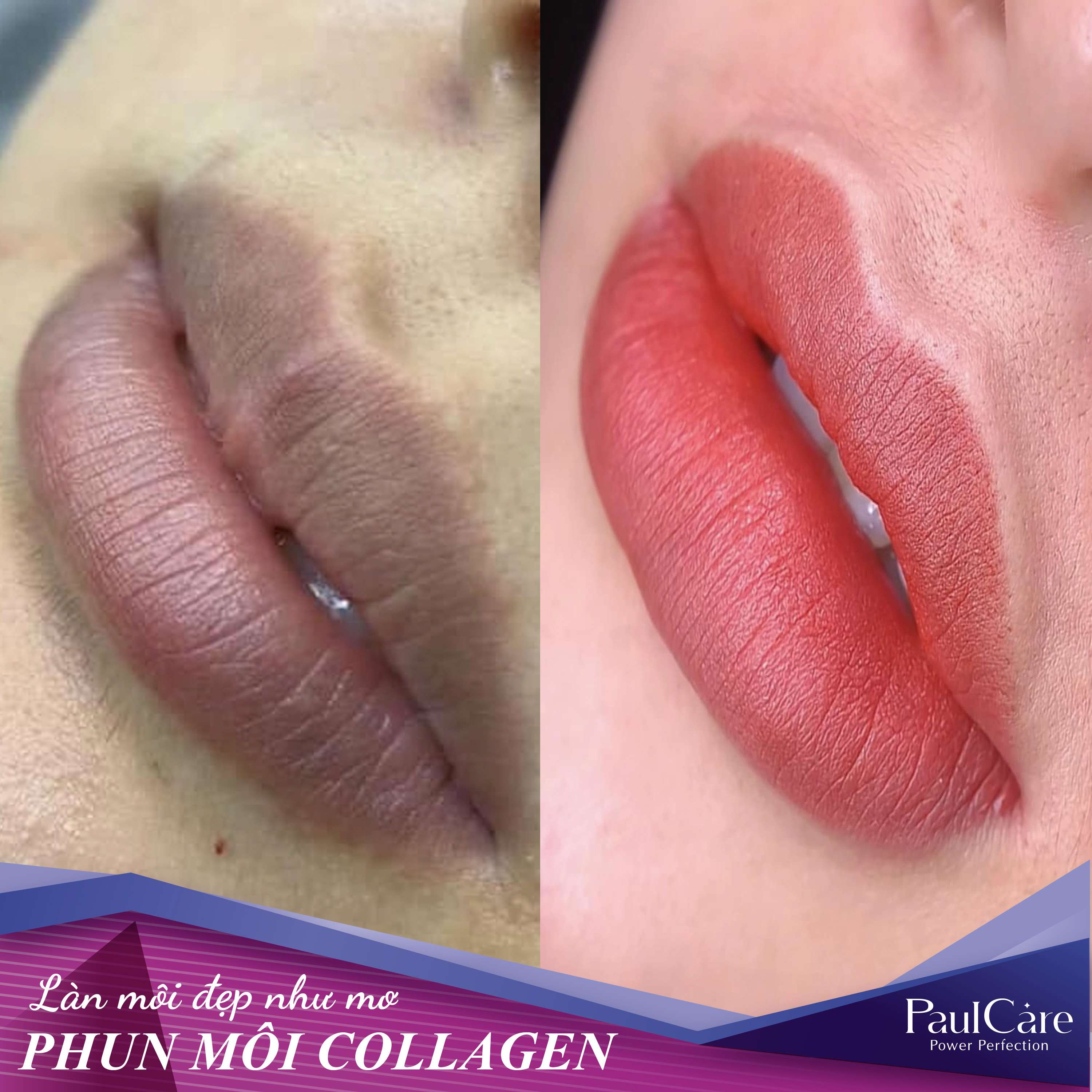 Truoc_va_sau_phun_moi_collagen_PaulCare