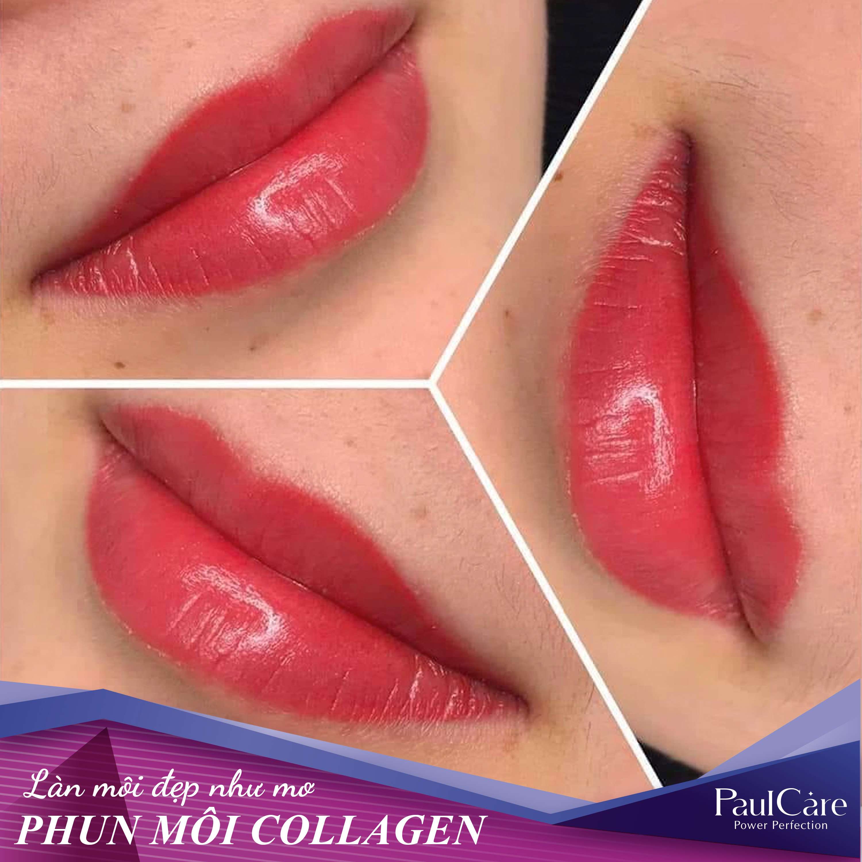 phun_moi_collagen_PaulCare